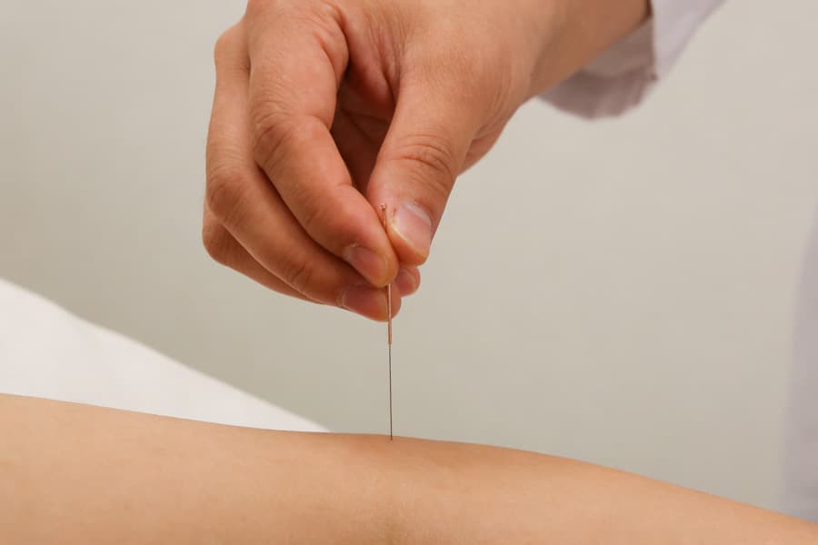 Acupuncture